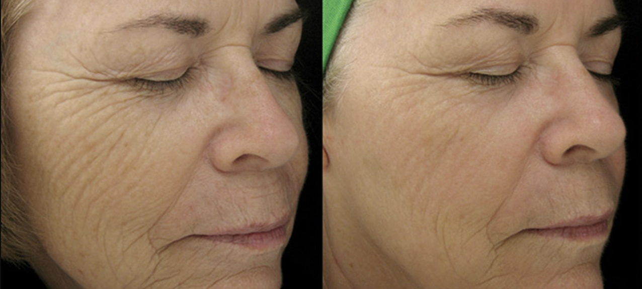 Laser Hautabtragung4 Vorher Nachher Dermatologie Hanau